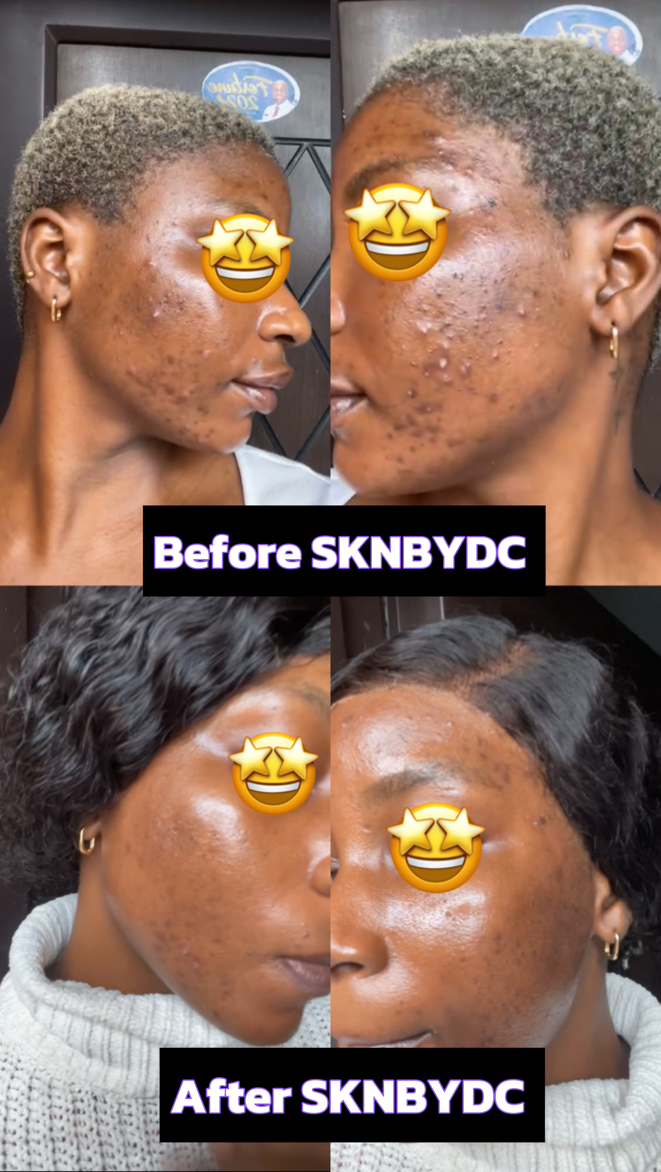 Acne-Free Journey